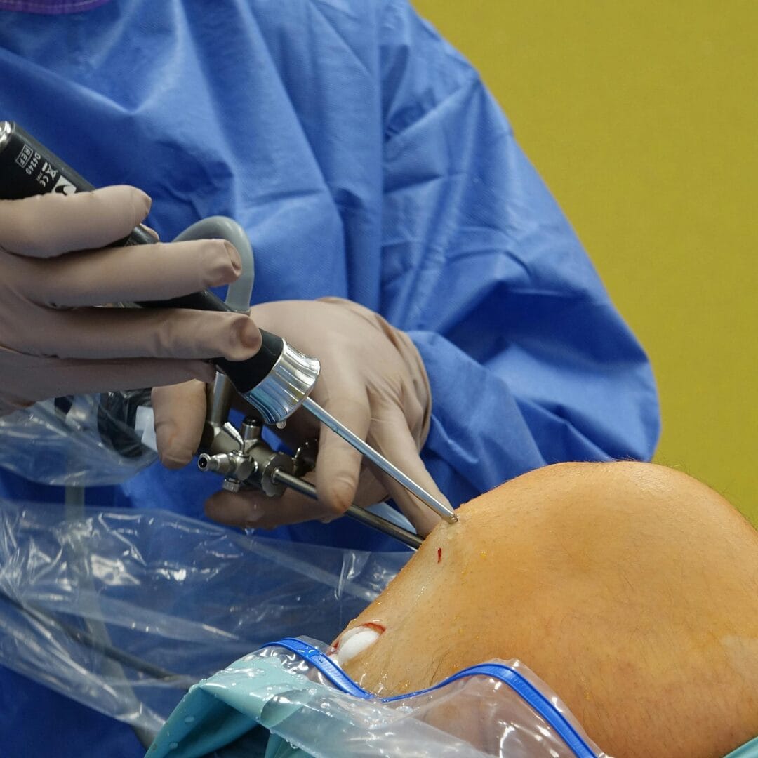 Arthroscopy Surgery at Pure Ortho Hospitals Sainikpuri Hyderabad