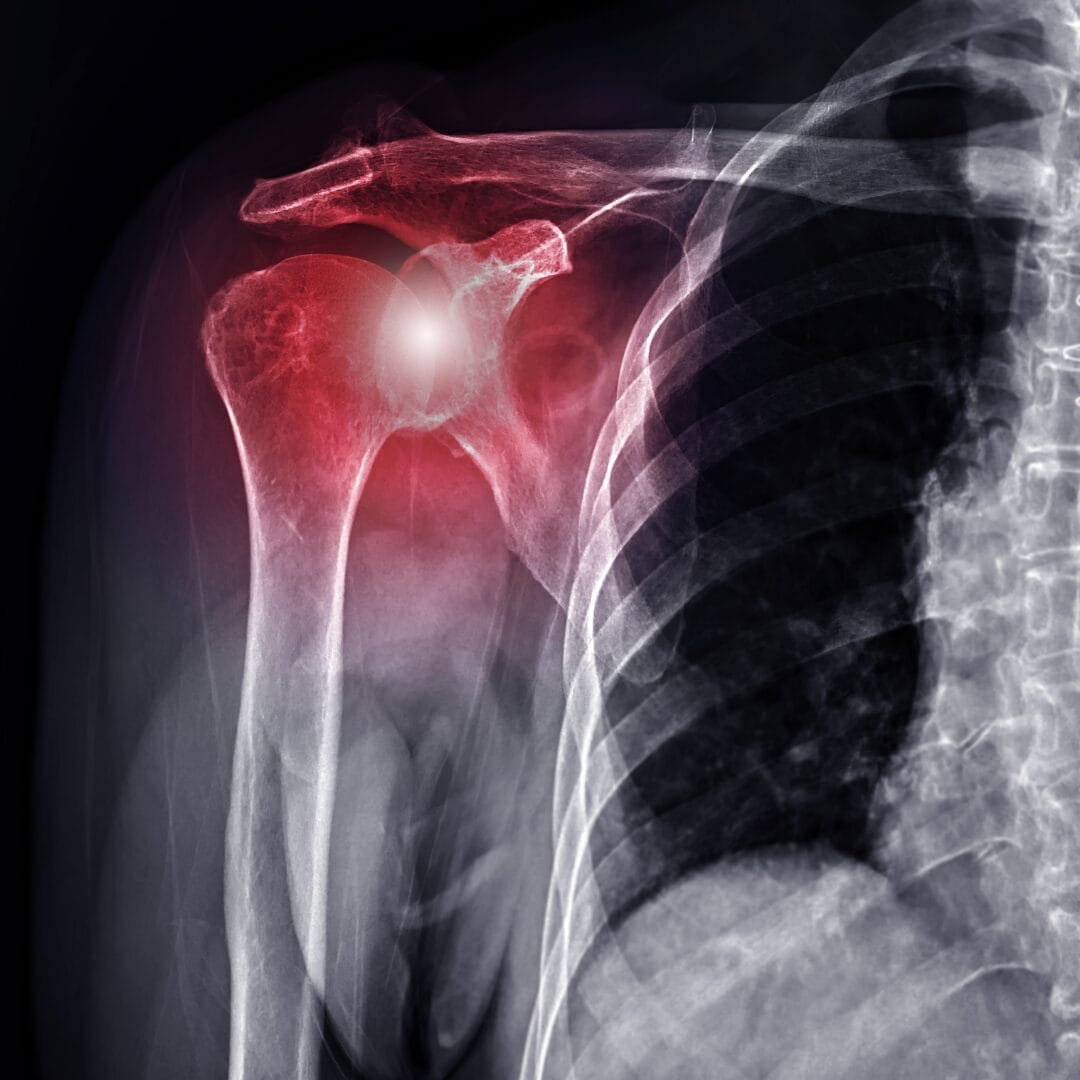 Frozen Shoulder Causes and Stages - Pure Ortho Hospitals Hyderabad