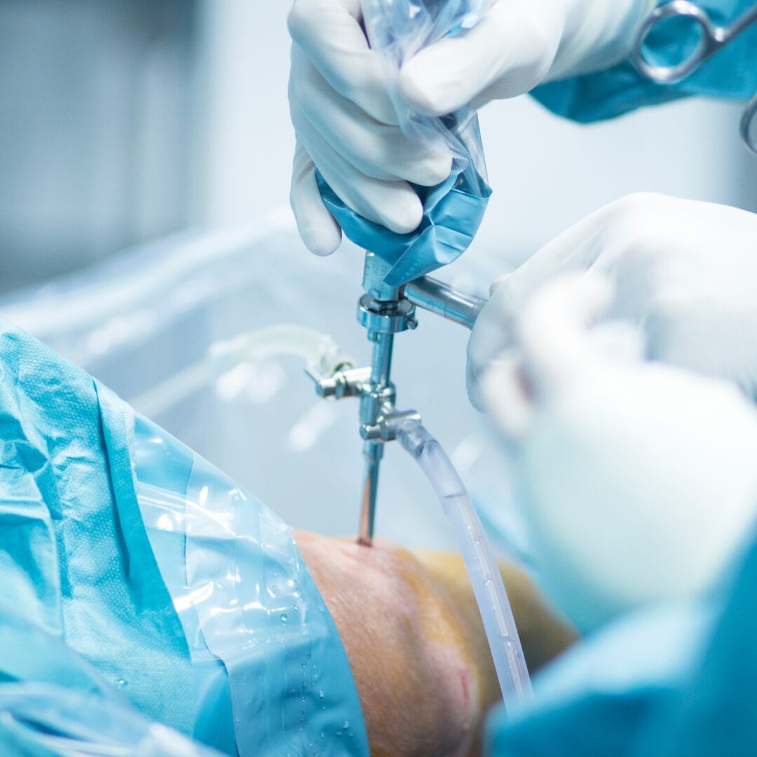 ACL reconstruction arthroscopic surgery Pure Ortho Hospitals Hyderabad