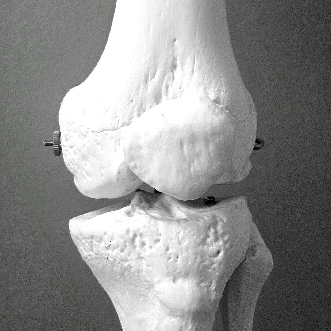 Low bone density osteoporosis India - Pure Ortho Hospitals Sainikpuri Hyderabad
