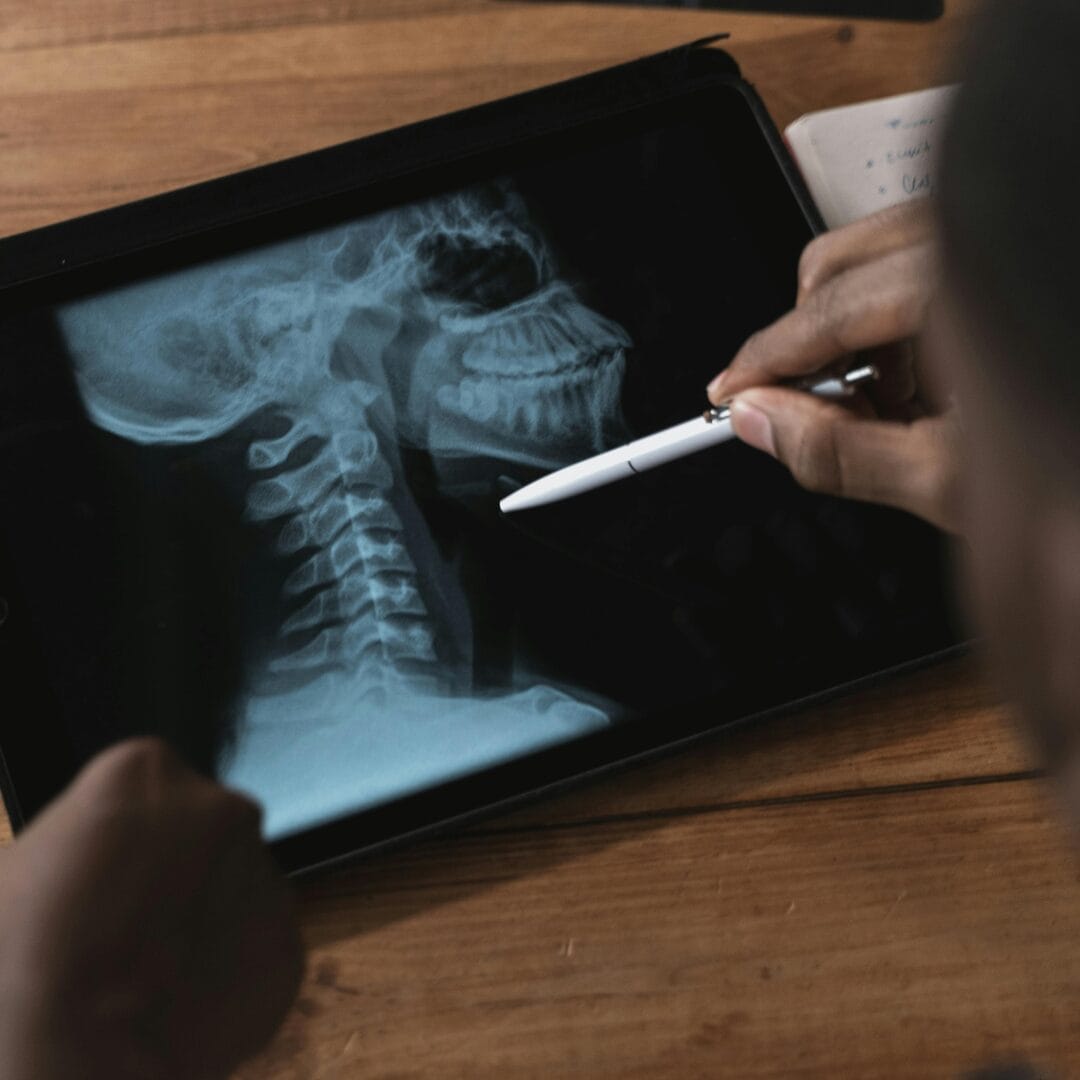 Cervical spine MRI bone spur disc degeneration Pure Ortho Hospitals Hyderabad