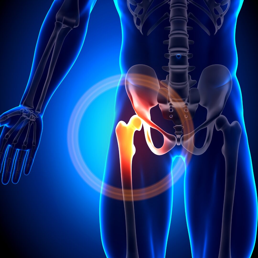 Vertebral compression fracture osteoporosis - spine treatment Pure Ortho Hospitals