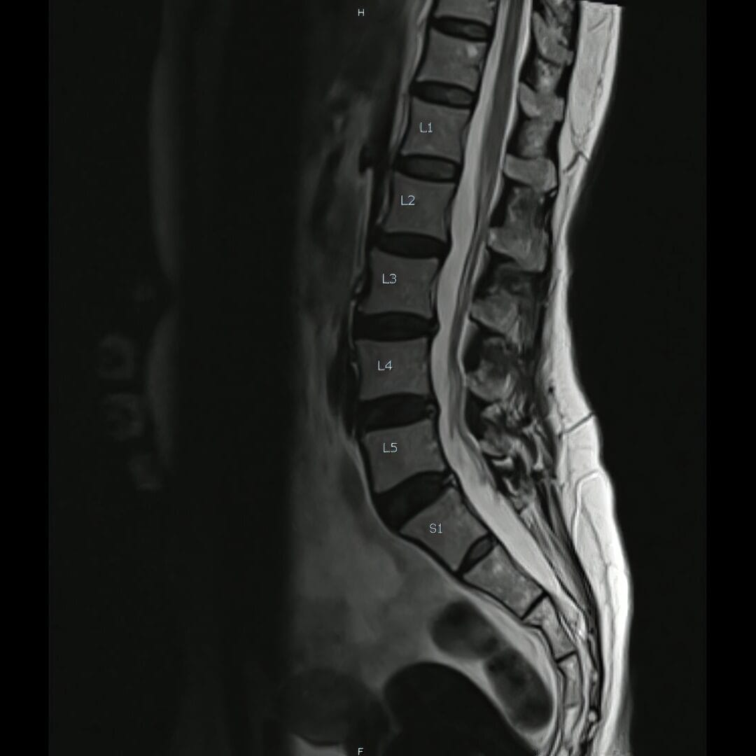 L4 L5 disc bulge MRI explained - Pure Ortho Hospitals Sainikpuri Hyderabad