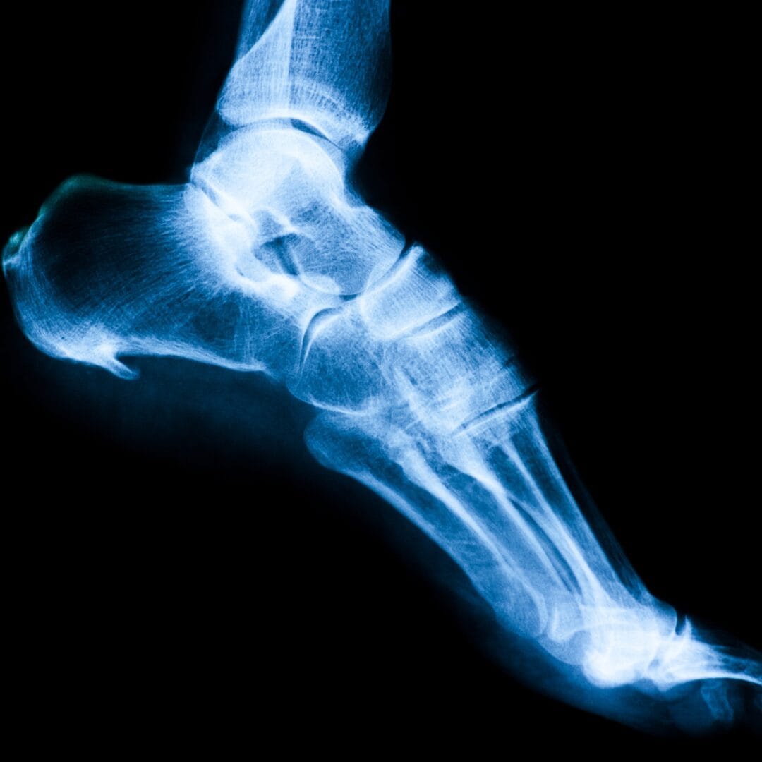 Heel spur calcaneal spur X-ray - Pure Ortho Hospitals Sainikpuri