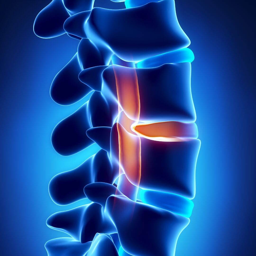Slip disc stages - L4 L5 disc bulge MRI - Pure Ortho Hospitals