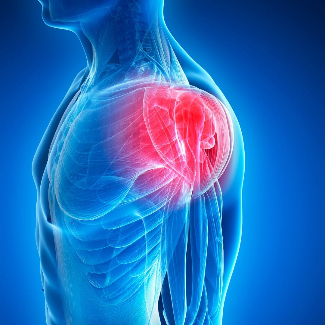 Rotator cuff tear shoulder tendon repair arthroscopy Pure Ortho Hospitals Sainikpuri Hyderabad