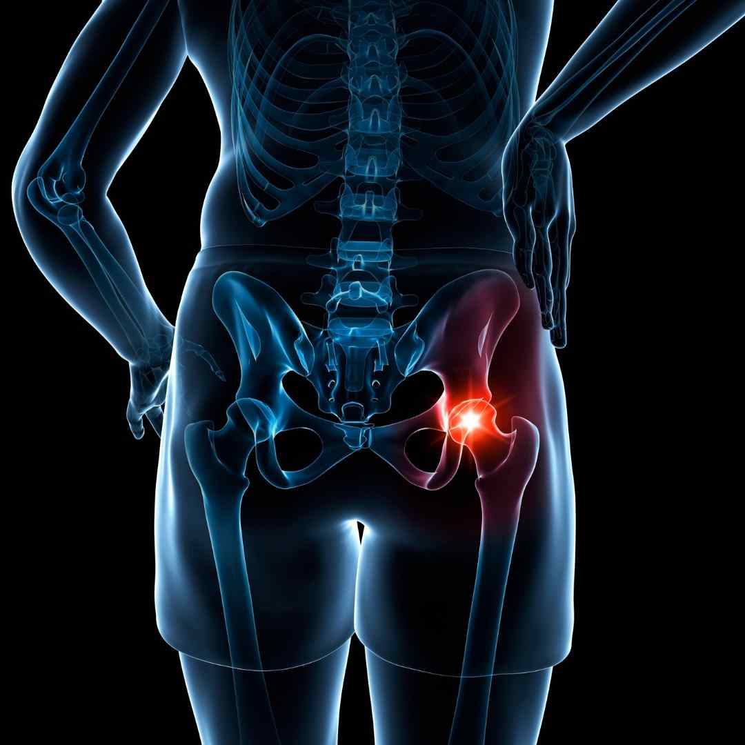 Hip replacement surgery AVN avascular necrosis Pure Ortho Hospitals Sainikpuri Hyderabad