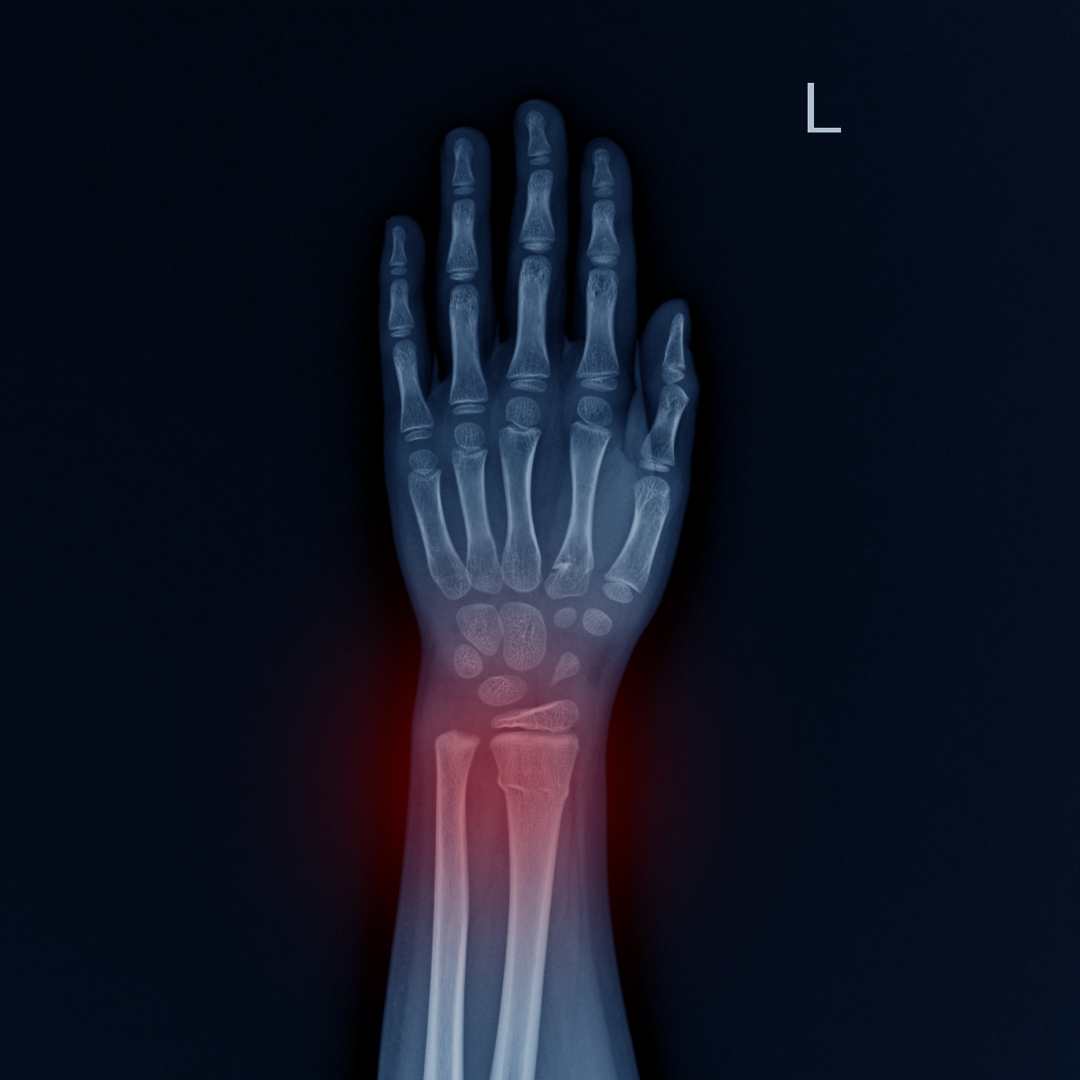 Child bone fracture X-ray paediatric orthopaedics Pure Ortho Hospitals Hyderabad