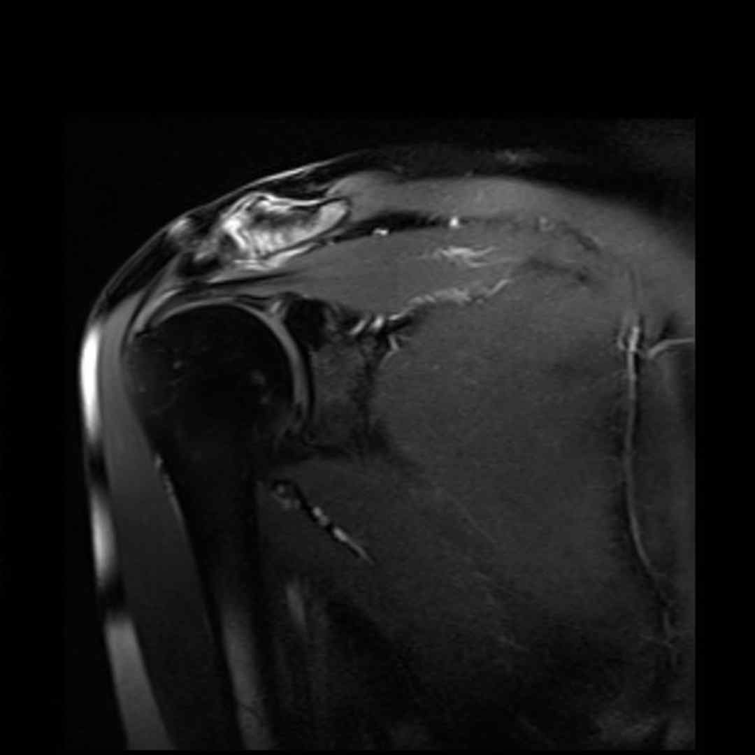 Shoulder MRI rotator cuff supraspinatus tear diagnosis Pure Ortho Hospitals Hyderabad