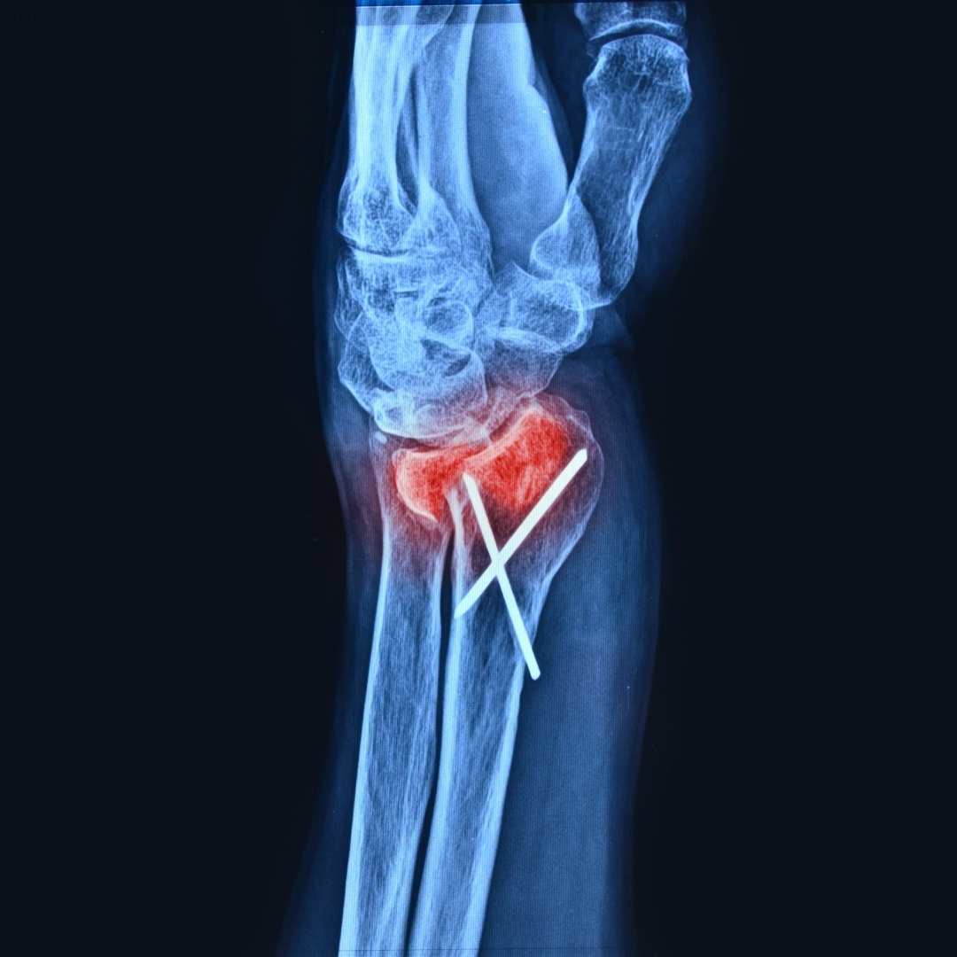 Stress fracture MRI bone scan diagnosis Pure Ortho Hospitals Sainikpuri Hyderabad