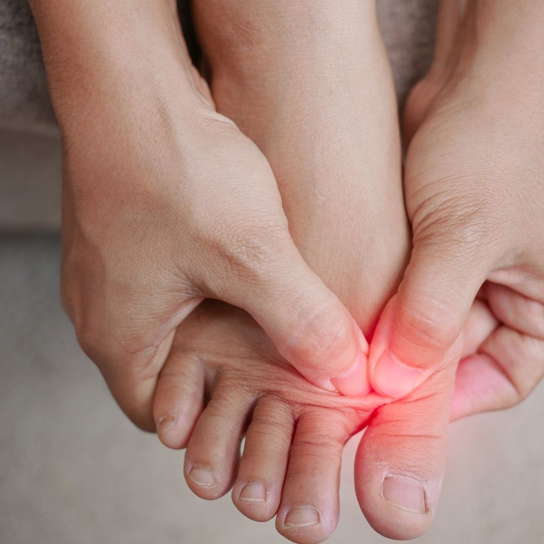 Bunion hallux valgus treatment Pure Ortho Hospitals Sainikpuri Hyderabad