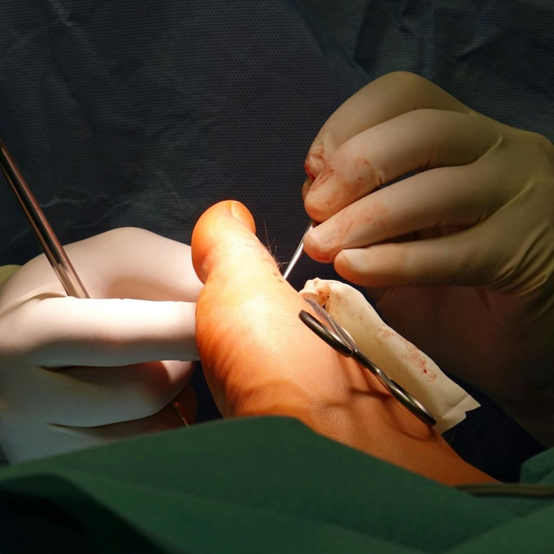 Bunion surgery osteotomy correction Pure Ortho Hospitals Hyderabad
