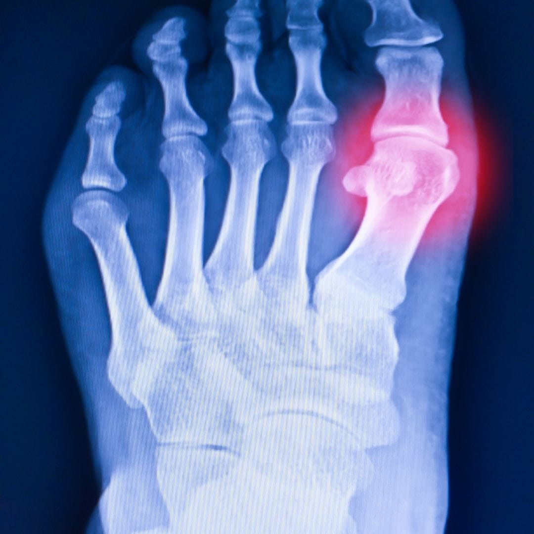 Gout big toe joint swelling uric acid crystal Pure Ortho Hospitals Hyderabad