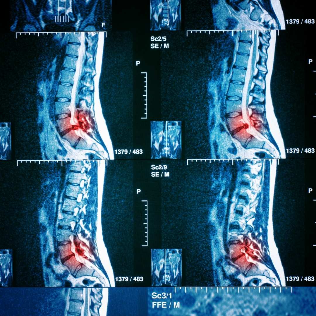 Spinal stenosis MRI laminectomy decompression Pure Ortho Hospitals Hyderabad