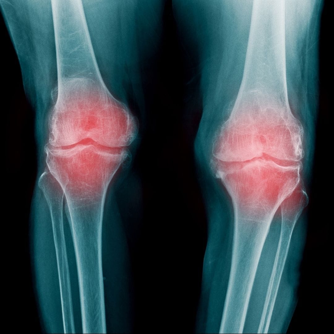 Knock knees X-ray genu valgum mechanical axis Pure Ortho Hospitals Hyderabad