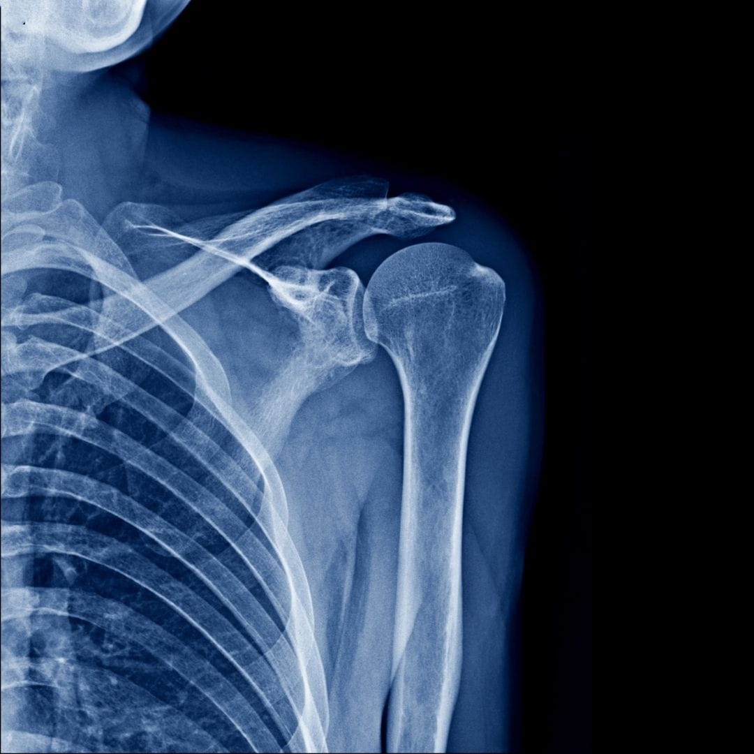 Osteoporosis silent bone disease India treatment Pure Ortho Hospitals Sainikpuri Hyderabad