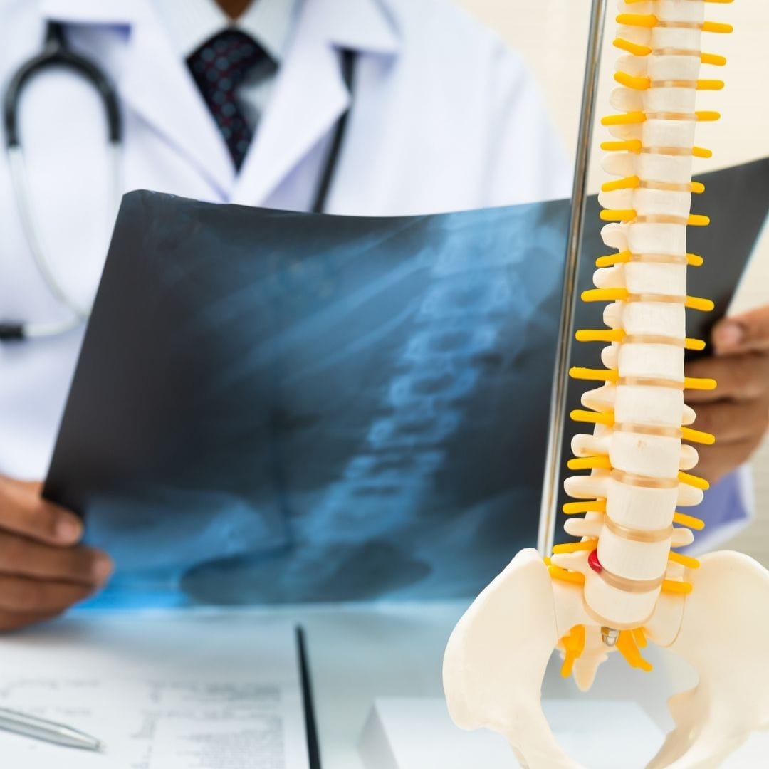 Osteoporosis bone density DEXA scan fracture risk Pure Ortho Hospitals Hyderabad