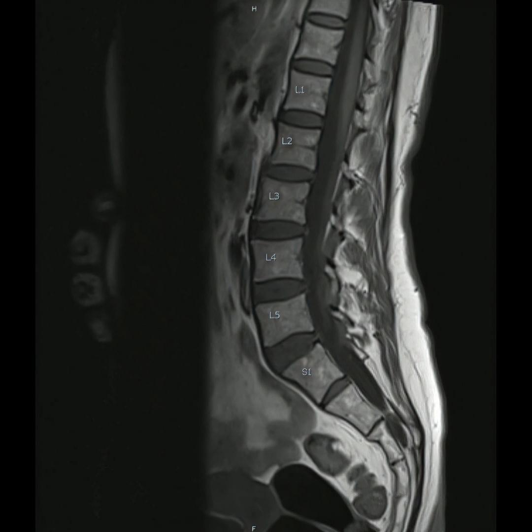Spine MRI disc prolapse endoscopic surgery Pure Ortho Hospitals Hyderabad