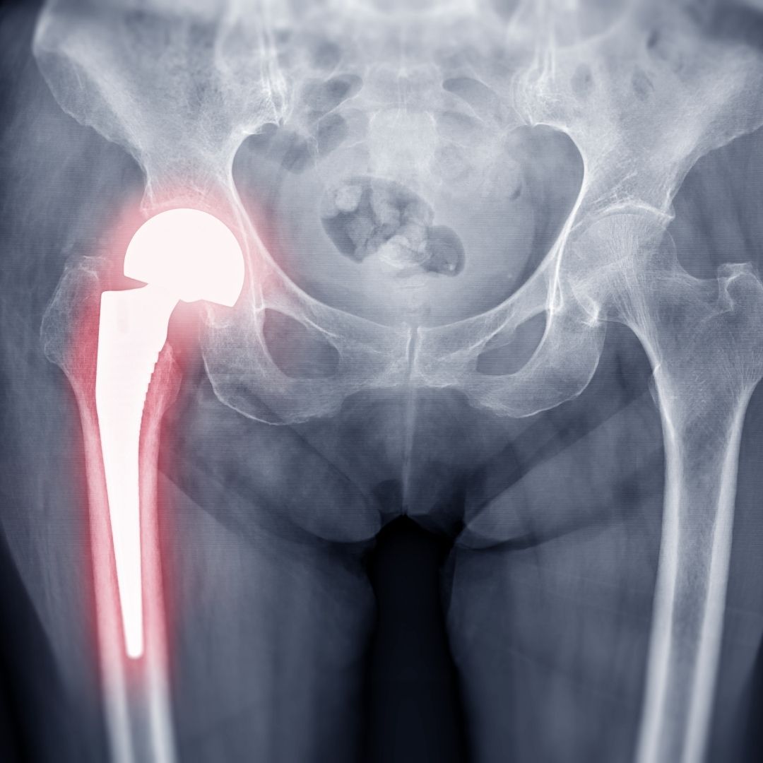 PFN proximal femoral nail X-ray hip fracture fixation Hyderabad Pure Ortho Hospitals